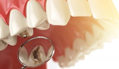 2026 Kanal Tedavisi Ücretleri Fiyatları Ne Durumda