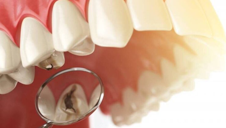 2026 Kanal Tedavisi Ücretleri Fiyatları Ne Durumda